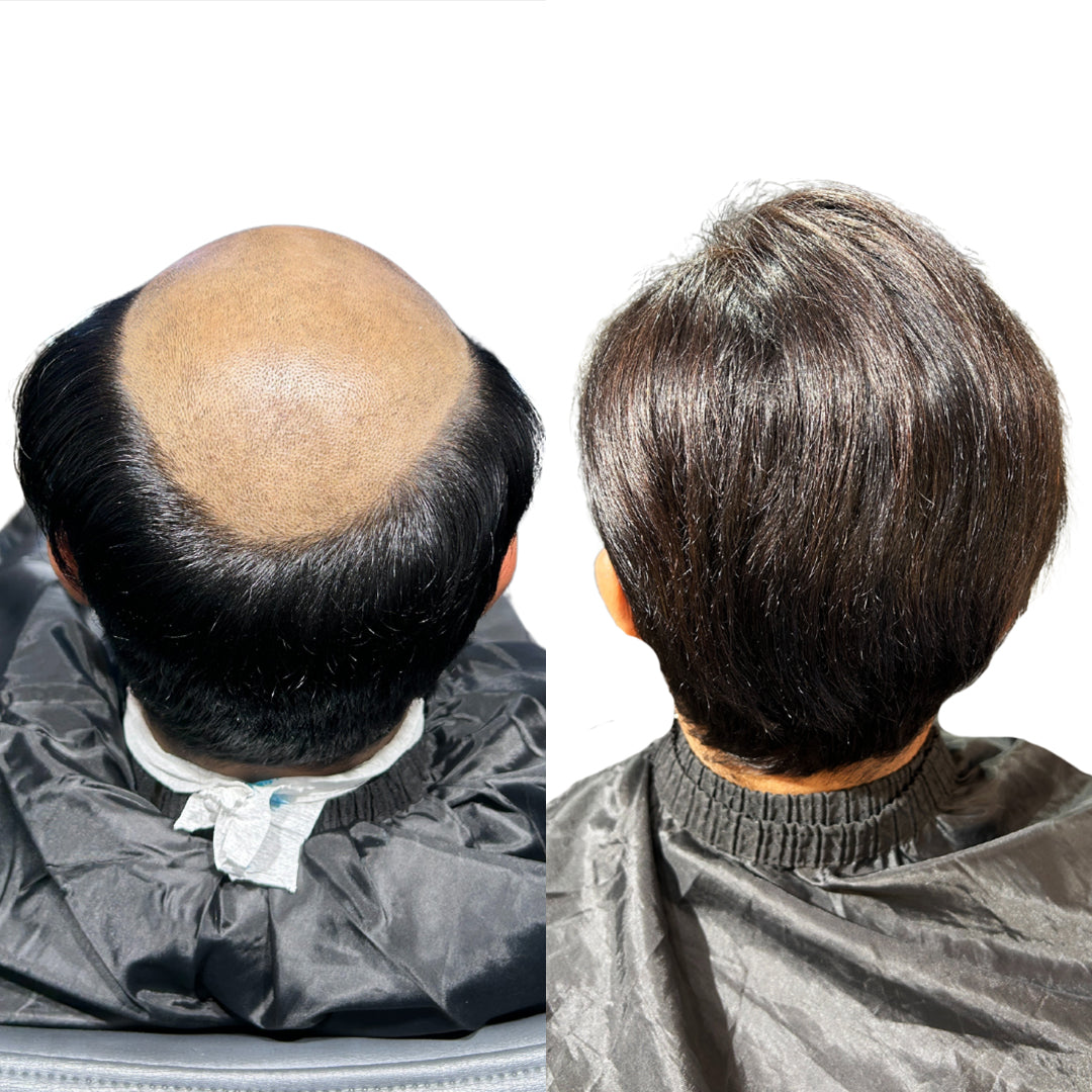 Men Patch - Monofilament